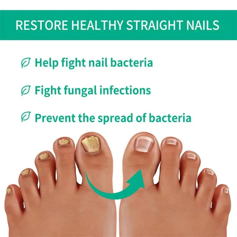 Fast Nail Fungus Treatment & Nail Repair Serum – Anti-Fungal Gel for Paronychia, Onychomycosis, Thick Nails, Nail Renewal & Strengthening Solution